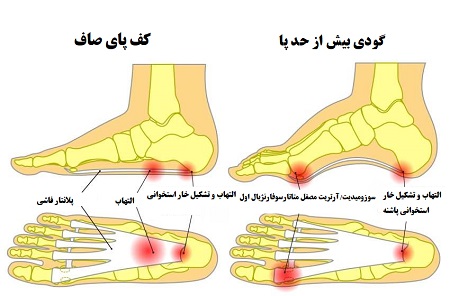 درد گودی کف پا: علل، علائم و راه‌های درمان