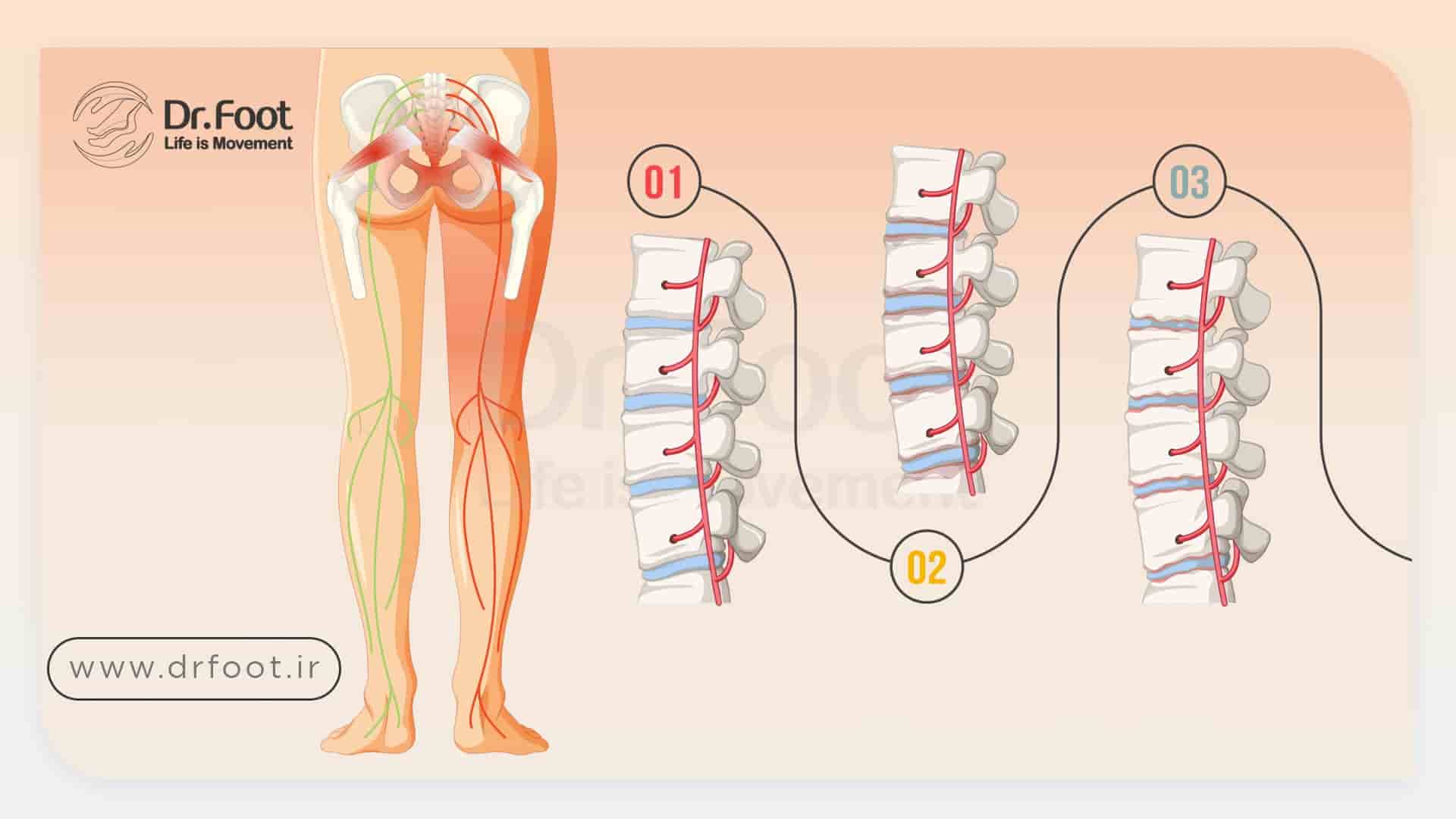 سیاتیک چیست؟ علت، تشخیص و درمان درد سیاتیک کمر و پا