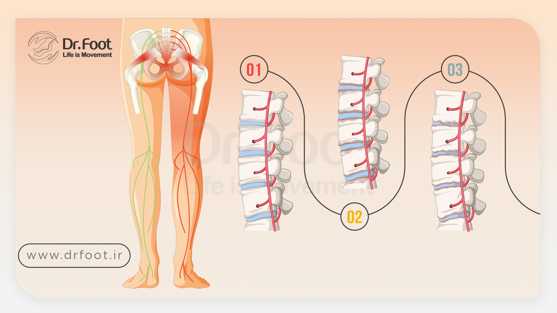 سیاتیک چیست؟ علت، تشخیص و درمان درد سیاتیک کمر و پا