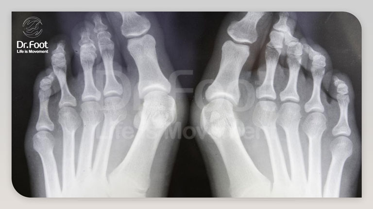 علل به وجود آورنده رشد اضافی استخوان انگشت پا