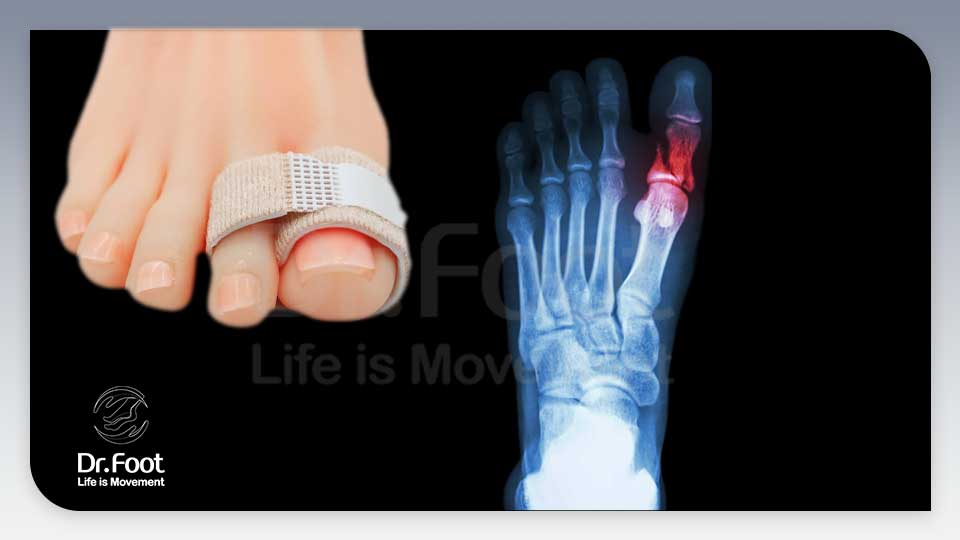 معیارهای تشخیصی جهت شکستگی انگشت پا