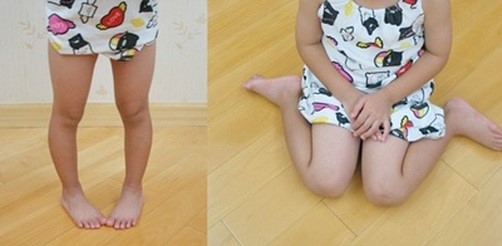 علل کج گذاشتن پا در کودکان و درمان