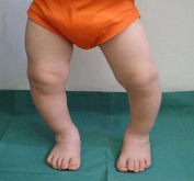 علل کج گذاشتن پا در کودکان و درمان