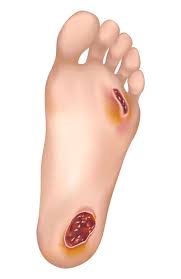 راهکارهای موثر برای درمان زخم پا
